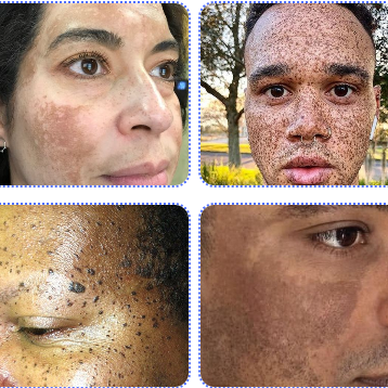 SAAM Crema facial renovadora - elimina melasma, pecas, manchas de la edad