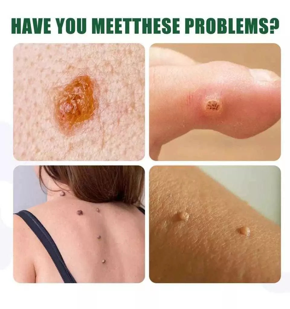 Parches de eliminación de verrugas