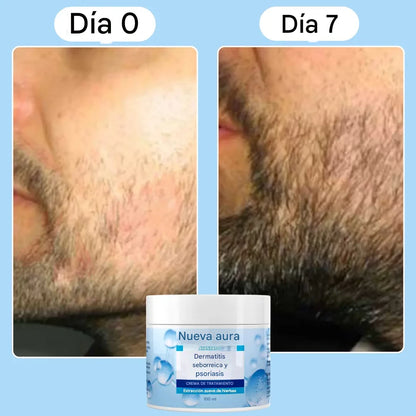 New aura Crema para la dermatitis seborreica y la psoriasis