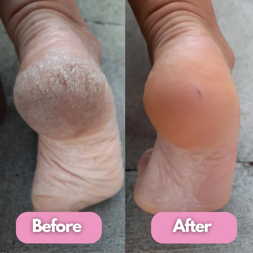 Removedor de callos eléctrico para pies BeautySpa