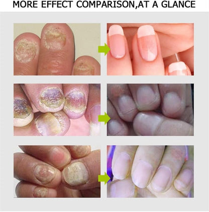 Eliminador de hongos de las uñas onicomicosis