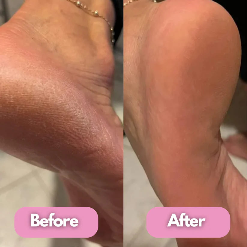 Removedor de callos eléctrico para pies BeautySpa