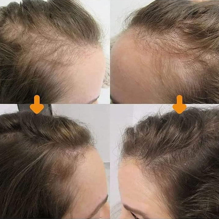 HairGrouth Serum para crecimiento de cabello, anticaída, fortalecimiento