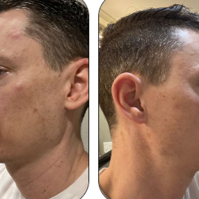 SAAM Crema facial renovadora - elimina melasma, pecas, manchas de la edad