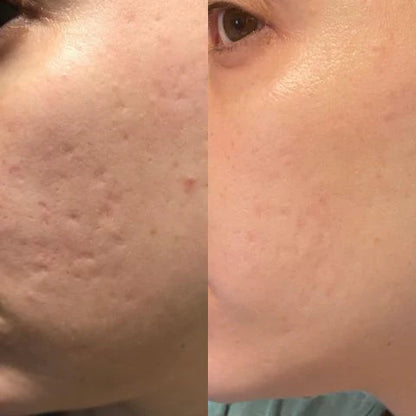 🎁PAGA 1 lleva 2 rollos de silicona para cicatrices 1.20 Metros largo