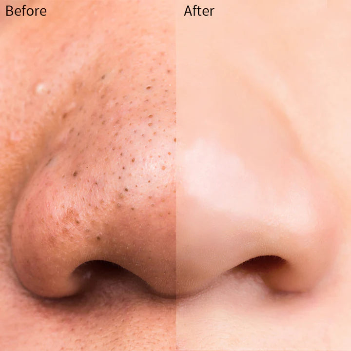 Parches para los poros, puntos negros kivory (pack de 10)