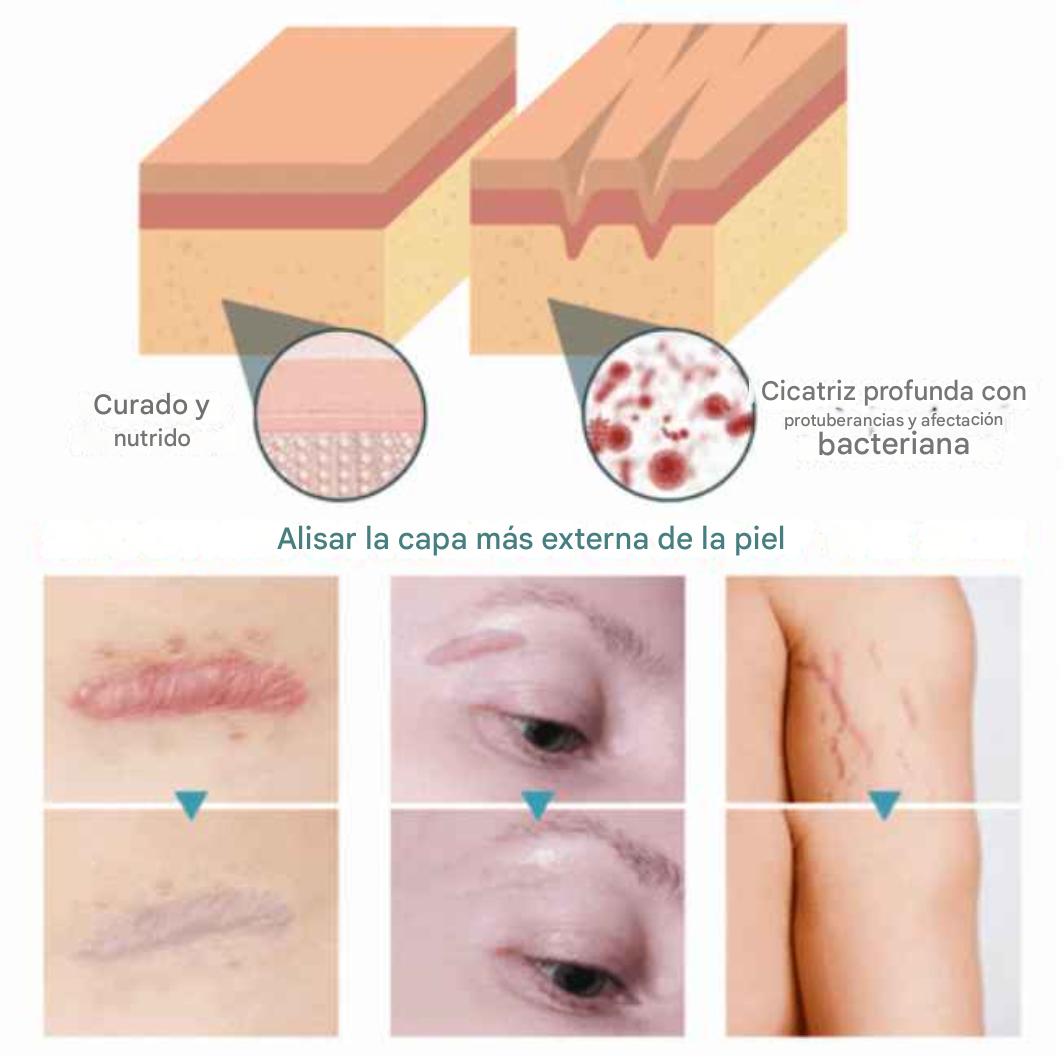 🎁PAGA 1 lleva 2 rollos de silicona para cicatrices 1.20 Metros largo