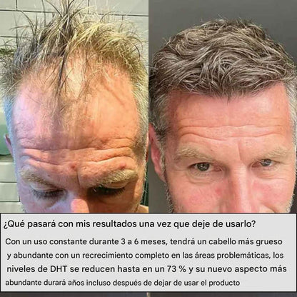 ALPHAINFUE REACTIVA AL INSTANTE EL CRECIMIENTO DEL CABELLO