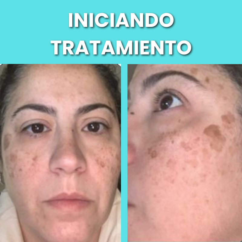 SAAM Crema facial renovadora - elimina melasma, pecas, manchas de la edad