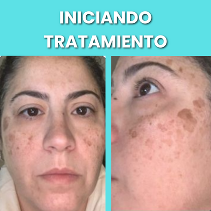 SAAM Crema facial renovadora - elimina melasma, pecas, manchas de la edad